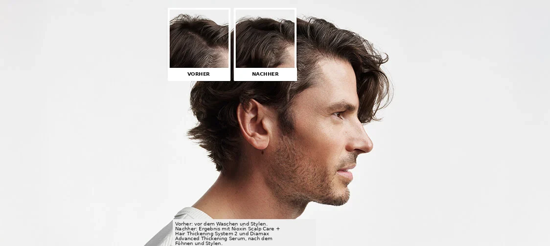 Nioxin System Kit 2 before and after image